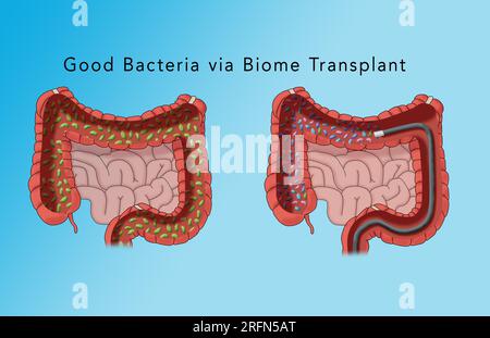 A conceptual illustration of the large intestine. The left one is filled with bad bacteria and the right intestine is filled wiht good or beneficial bacteria. Stock Photo