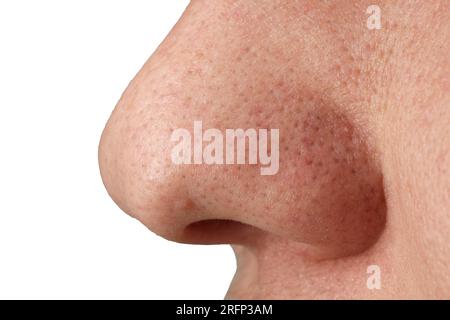 Young man with acne problem on white background, closeup Stock Photo