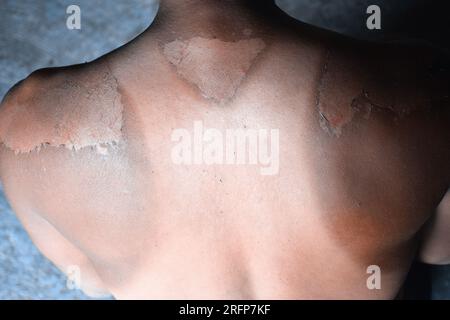 Sunburn on a man's back. Strong tan in the man. Red hands and back. Sore skin, blistered. No sun protection Stock Photo