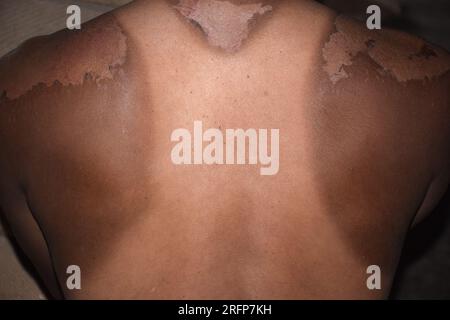 Sunburn on a man's back. Strong tan in the man. Red hands and back. Sore skin, blistered. No sun protection Stock Photo