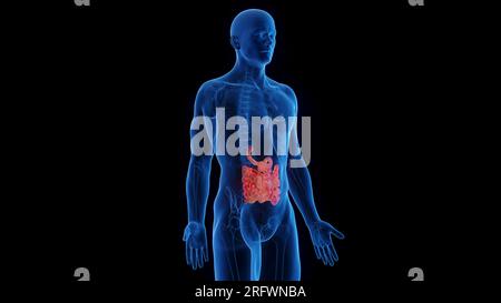 Inflamed small intestine, illustration Stock Photo - Alamy