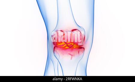 Inflamed knee, illustration Stock Photo