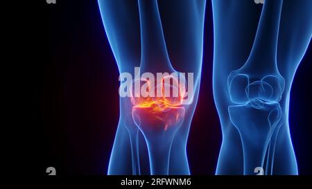 Inflamed knee, illustration Stock Photo