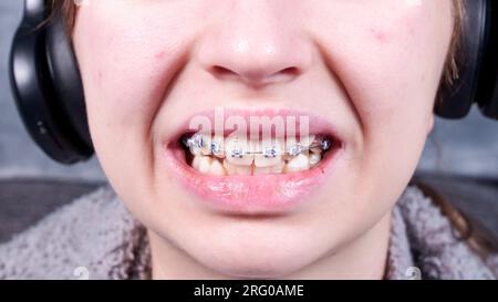Happy smiling teenage girl with dental braces and face acne. Orthodontic treatment Stock Photo