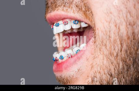 Bracket system in smiling mouth, macro photo teeth, close-up lips, macro shot, dentist. Man braces. Teeth braces on the white teeth of man to equalize Stock Photo