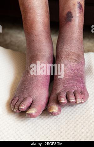 Bad ciculation in elderly womans feet. Stock Photo