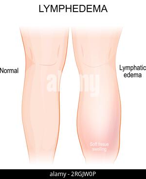 Lymphedema. lymphoedema. Healthy leg, and lymphatic edema. swelling leg and foot that caused by a compromised lymphatic system. Part of human body. Ve Stock Vector