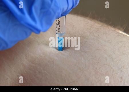 Needle injecting into the muscle. Nurse doing a trigger point injection in patient back. Close up doctor makes an shot therapy. Alternative pain treat Stock Photo