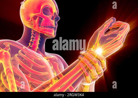 Wrist pain, illustration Stock Photo