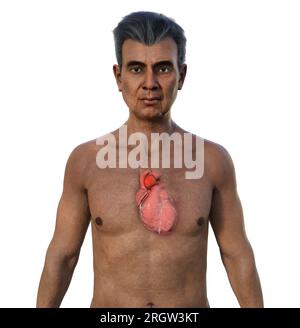 Ascending aortic aneurysm, illustration Stock Photo - Alamy