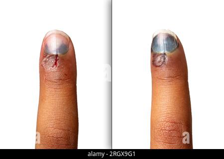 Evolution after a few days of the hematoma of a crushed finger, collage of before and after the development of the black nail Stock Photo
