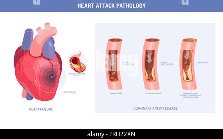 Pathology of a heart attack and atherosclerosis medical illustration infographic Stock Vector
