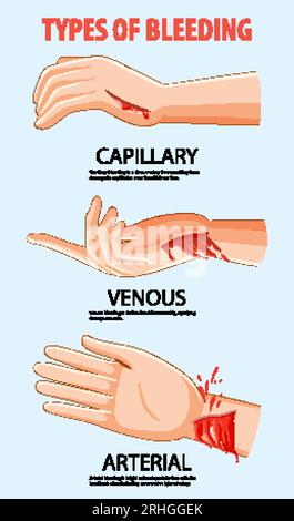 vector illustration of a Arterial and venous bleeding Stock Vector ...