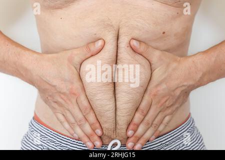 Unrecognisable obesity man touches fat and cellulite belly waistline suffering from extra weight. Concept of unhealthy eating and lifestyle, health pr Stock Photo