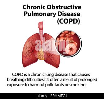 Illustrated infographic explaining chronic obstructive pulmonary ...