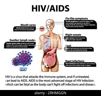 Illustrated infographic depicting the impact of HIV/AIDS on the body Stock Vector