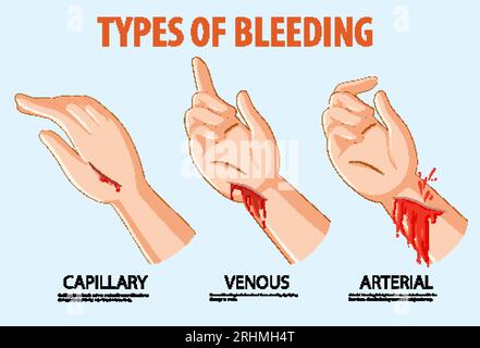 vector illustration of a Arterial and venous bleeding Stock Vector ...