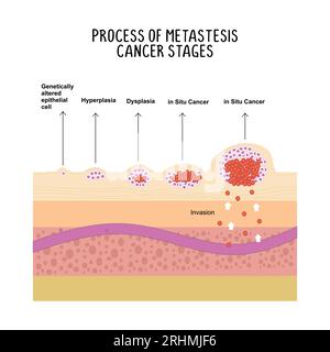 process of metastases cancer stages illustration isolated on white background. Stock Vector