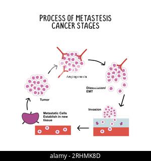 process of metastases cancer stages illustration isolated on white background. Stock Vector