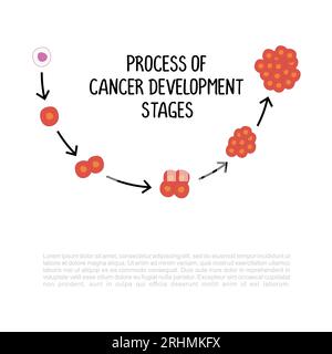 process of cancer development stages illustration isolated on white background. Stock Vector