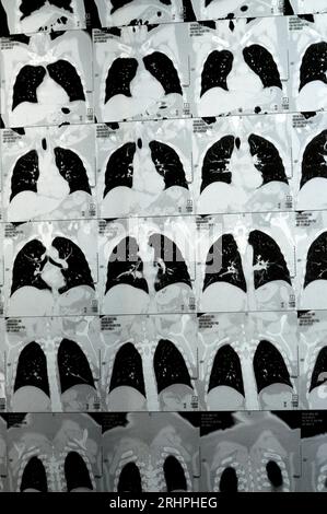 Multi slice CT scan of the chest showing normal study, normal ...