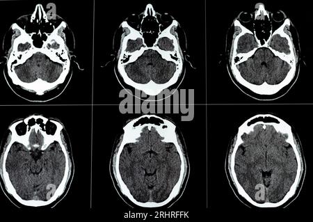 Brain CT scan showing brainstem cavernoma, right centrum semiovale developmental venous anomaly, intra cerebral haematoma, faint hypodense lesion in m Stock Photo