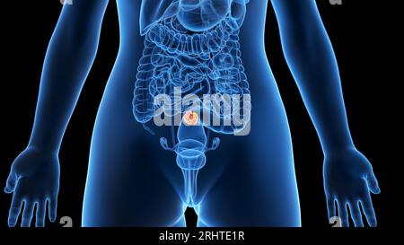 Colorectal cancer, malignant tumor in intestine, Endoscope inside ...