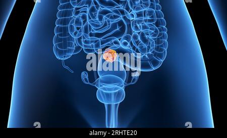 Colorectal cancer, malignant tumor in intestine, Endoscope inside ...