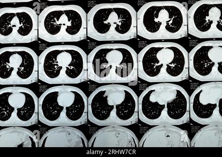 Multi slice CT scan of the chest showing normal study, normal appearance of the lungs, parenchyma, pulmonary vasculature,  mediastinal structures, no Stock Photo