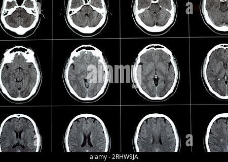 Brain CT scan showing brainstem cavernoma, right centrum semiovale developmental venous anomaly, intra cerebral haematoma, faint hypodense lesion in m Stock Photo