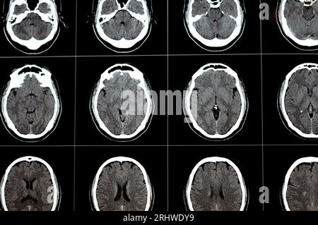 Brain CT scan showing brainstem cavernoma, right centrum semiovale developmental venous anomaly, intra cerebral haematoma, faint hypodense lesion in m Stock Photo