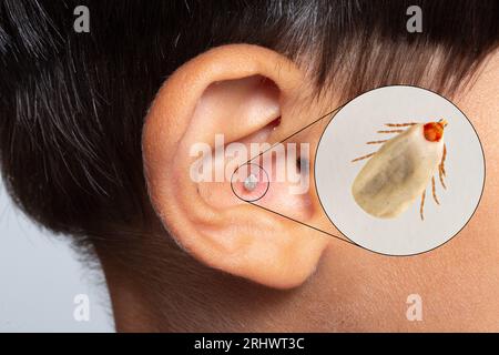 Blood sucking tick, attached to the ear of a human child. Concept of transmission of dangerous diseases, risk of vector insect infection. Lyme disease Stock Photo