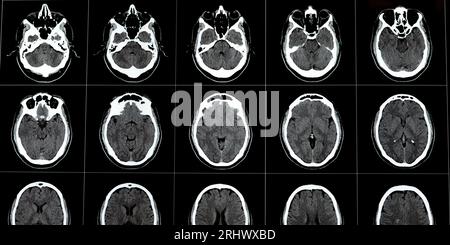 Brain CT scan showing brainstem cavernoma, right centrum semiovale developmental venous anomaly, intra cerebral haematoma, faint hypodense lesion in m Stock Photo