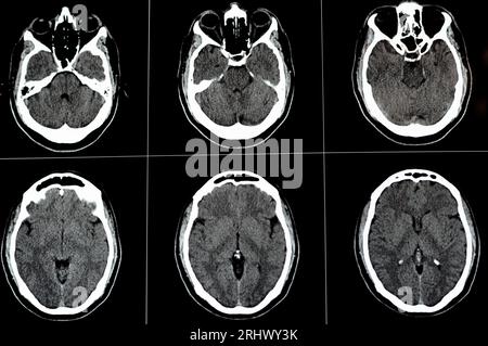 Brain CT scan showing brainstem cavernoma, right centrum semiovale developmental venous anomaly, intra cerebral haematoma, faint hypodense lesion in m Stock Photo