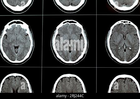 Brain CT scan showing brainstem cavernoma, right centrum semiovale developmental venous anomaly, intra cerebral haematoma, faint hypodense lesion in m Stock Photo