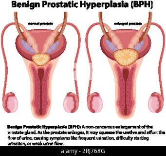 Cartoon-style infographic illustrating male benign prostatic hyperplasia Stock Vector