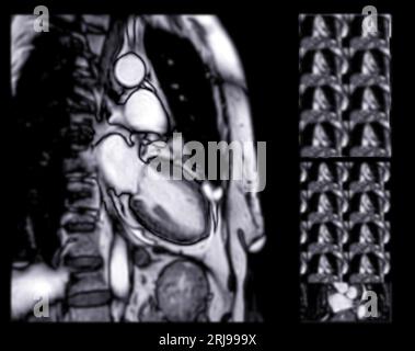 MRI heart or Cardiac MRI ( magnetic resonance imaging ) of heart in ...