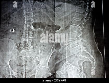 Plain X Ray Of The Lumber Spine In Ap And Lateral Views, Marginal 