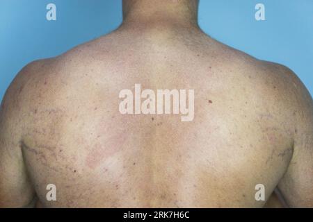 A man suffering from the skin condition Tinea Versicolor with discolored patches on the skin Stock Photo