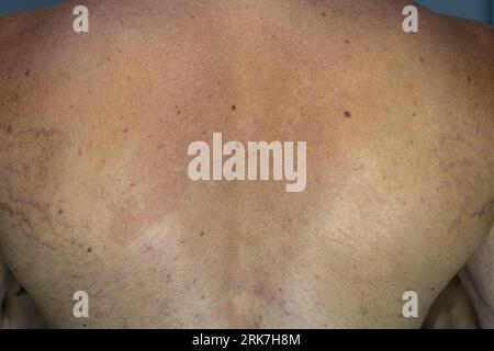 A man suffering from the skin condition Tinea Versicolor with discolored patches on the skin Stock Photo
