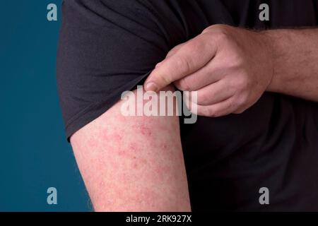 Close up of Erysipelas on the hand. A red rash appears on the forearm Stock Photo
