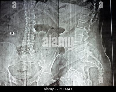 Plain x ray of the lumber spine in AP and lateral views, marginal ...