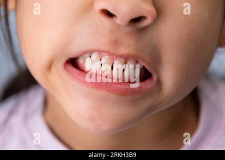Headshot cropped image of cute preschool girl smiling wide showing milk teeth. Close-up of a child's white teeth. Stock Photo