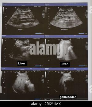 Ultrasonography of the upper abdomen with visualized portions of the aorta, pancreas, liver and gallbladder Stock Photo