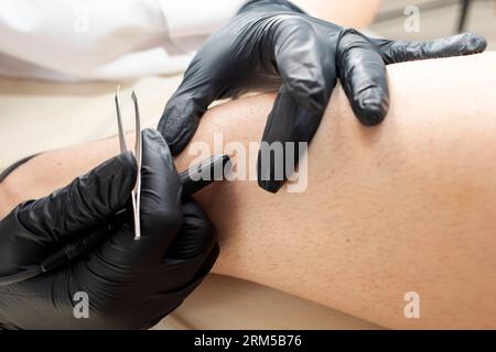 Unrecognizable Dermatologist Doing Hair Removal Electrolysis Procedure On Woman's Leg, Shin. Hirsutism, Excess hair. Electric Epilation In Beauty Stock Photo