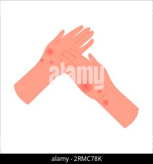 Human hands with allergic reaction. Hands covered with red itchy rash flat vector illustration Stock Vector
