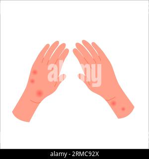 Human hands covered with red rash. Allergic itchy reaction, atopic dermatitis flat vector illustration Stock Vector