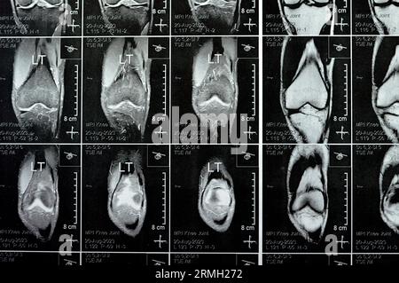 MRI of left knee joint showing minimal joint effusion, PHMM Posterior Horn Medial Meniscus degeneration, ACL anterior cruciate ligament mild sprain, n Stock Photo