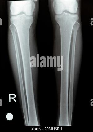 Plain X ray of both right and left knee joints with lower part of femur and upper parts of tibia and fibula and patella showing normal knee join of a Stock Photo