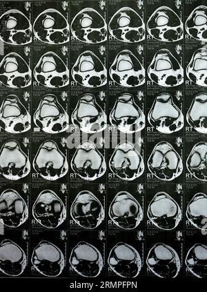 MRI of the right knee showing mild joint effusion, with normal other findings of PHMM, ACL, MCL, LCL, LM, ligaments, patella, tendons, nerves, muscles Stock Photo